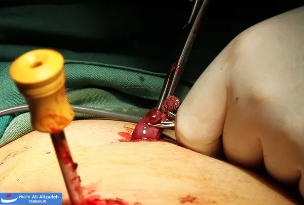 Cholecystectomy كله سيستكتومی (برداشتن كيسه صفرا به دليل التهاب ناشی از سنگ يا پوليپ كيسه صفرا)