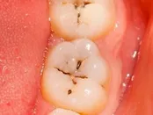 پنج روز مسواک نزدن چه بر سر دهان می‌آورد؟
