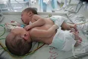تولد نوزادان دوقلوی به هم چسبیده