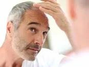 انواع روش درمانی ریزش مو برای مردان