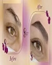 میکروبلیدینگ در مرکز تخصصی مریم حمزه‌ای