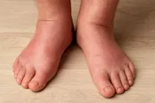 هشدار برای افرادی که پاهایشان بی‌دلیل ورم می‌کند