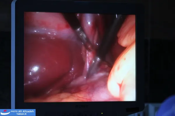 جداکردن کیسه صفرای ملتهب بوسیله گیره های وارد شده به بدن بیمار