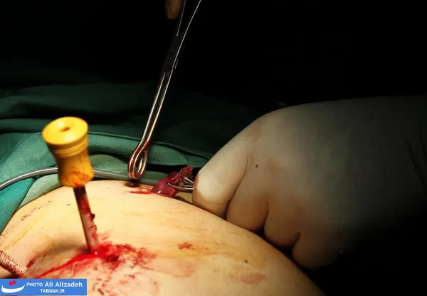 Cholecystectomy كله سيستكتومی (برداشتن كيسه صفرا به دليل التهاب ناشی از سنگ يا پوليپ كيسه صفرا)