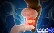 آیا سرطان پروستات کشنده است؟