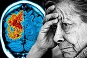 چرا آلزایمر در زنان بیشتر دیده می شود؟